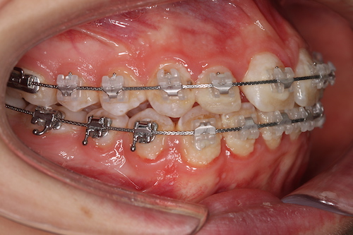 Почему клыки темнее других зубов? Могут ли пломбы простоять вечно?